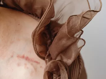 close up of a women's shoulder focused on a scar.