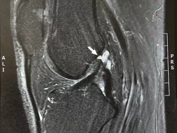 Sagittal MRI of the left knee showing ACL rupture.