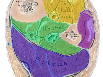 cross-section of the lower leg showing the tibia, fibula, and four compartments.
