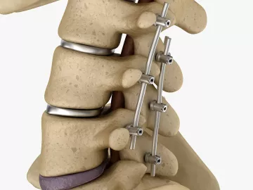 rods placed through a couple vertebrae of the lumbar spine. 