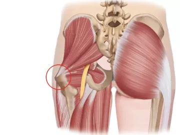 posterior view of the gluteus, showing the sciatic nerve pathway and greater trochanter.