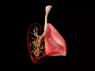 Two pink lungs, one with lines indicating scar tissue deposits. 