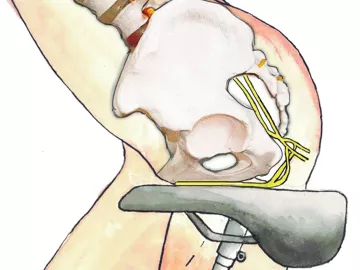 Illustration of a buttocks sitting on a slim, hard bicycle saddle can compress the pudendal nerve.