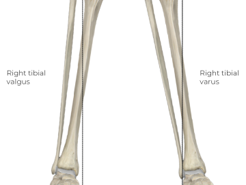 A labeled anatomical diagram of two tibia bones left and right, showing valgus and varus angulations.