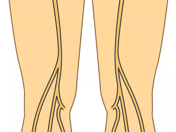 Illustration of the lower torso with the sciatic nerve and other nerves highlighted.